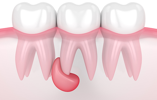 Kyste-dentaire-Dentiste-Toulouse