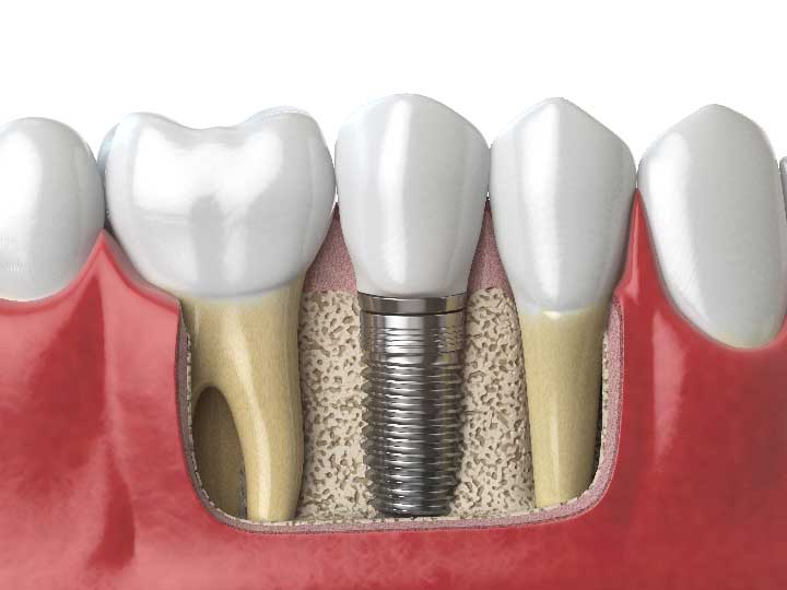 anatomy-of-healthy-teeth-and-tooth-dental-implant--PAF6ZMW