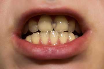 carie-de-la-petite-enfance-tb