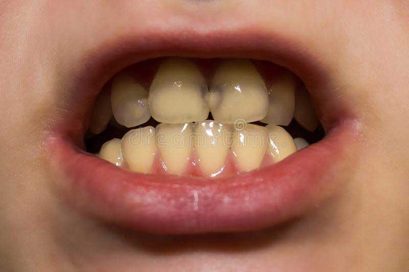 carie-de-la-petite-enfance