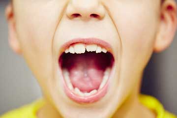 chevauchement-dentaires-tb