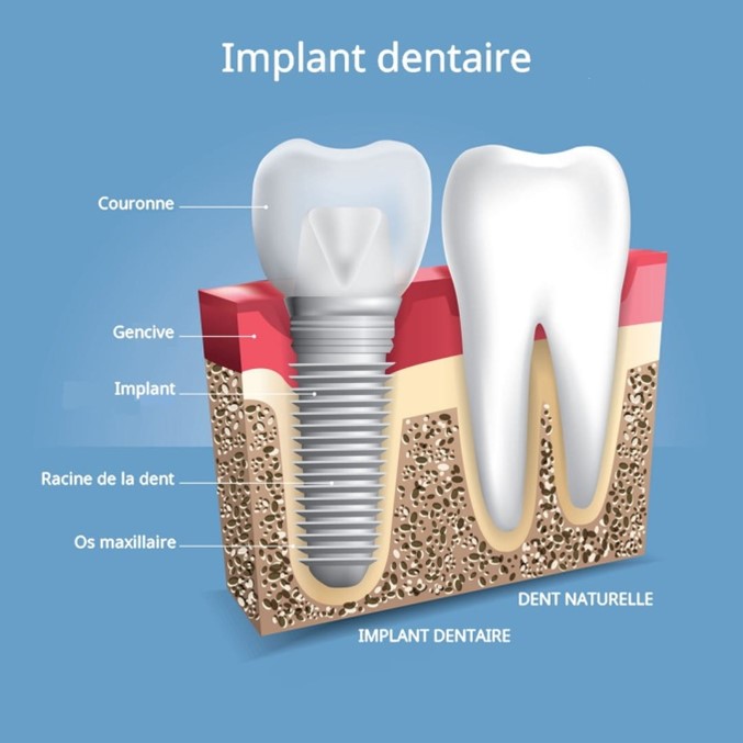 Implant